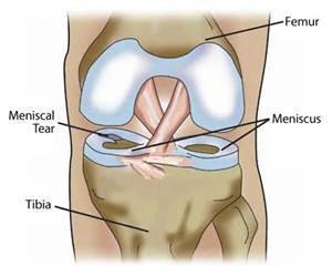 Meniscus-Tear