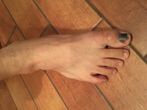 Avoid Losing Toenails